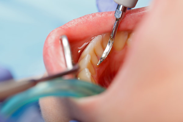 questions about dental implants