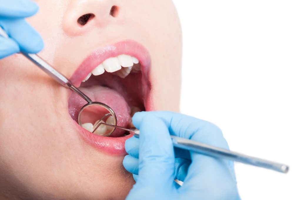 dental veneers maintenance