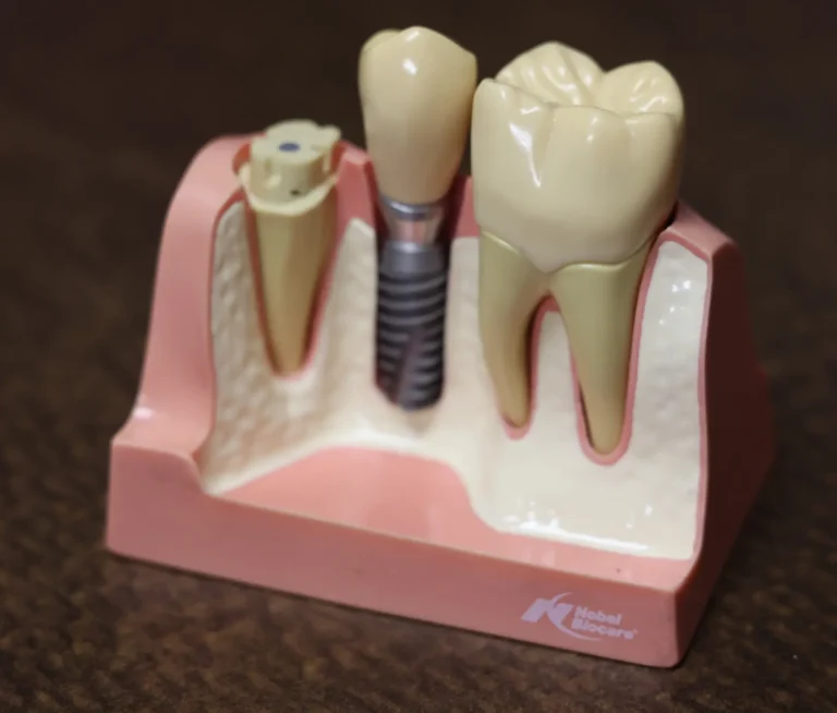 ceramic implants vs titanium