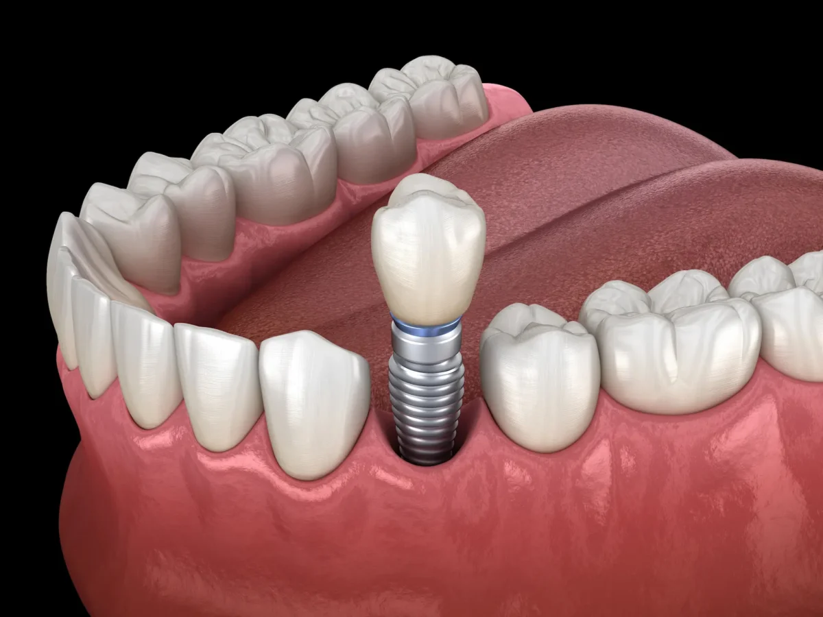 what is a dental implant